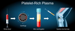 Regenerative Medicine and Orthobiologics in Natick, Wellesley & Weston, MA